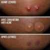 COSRX Acne Pimple Master Patch Anti-imperfections