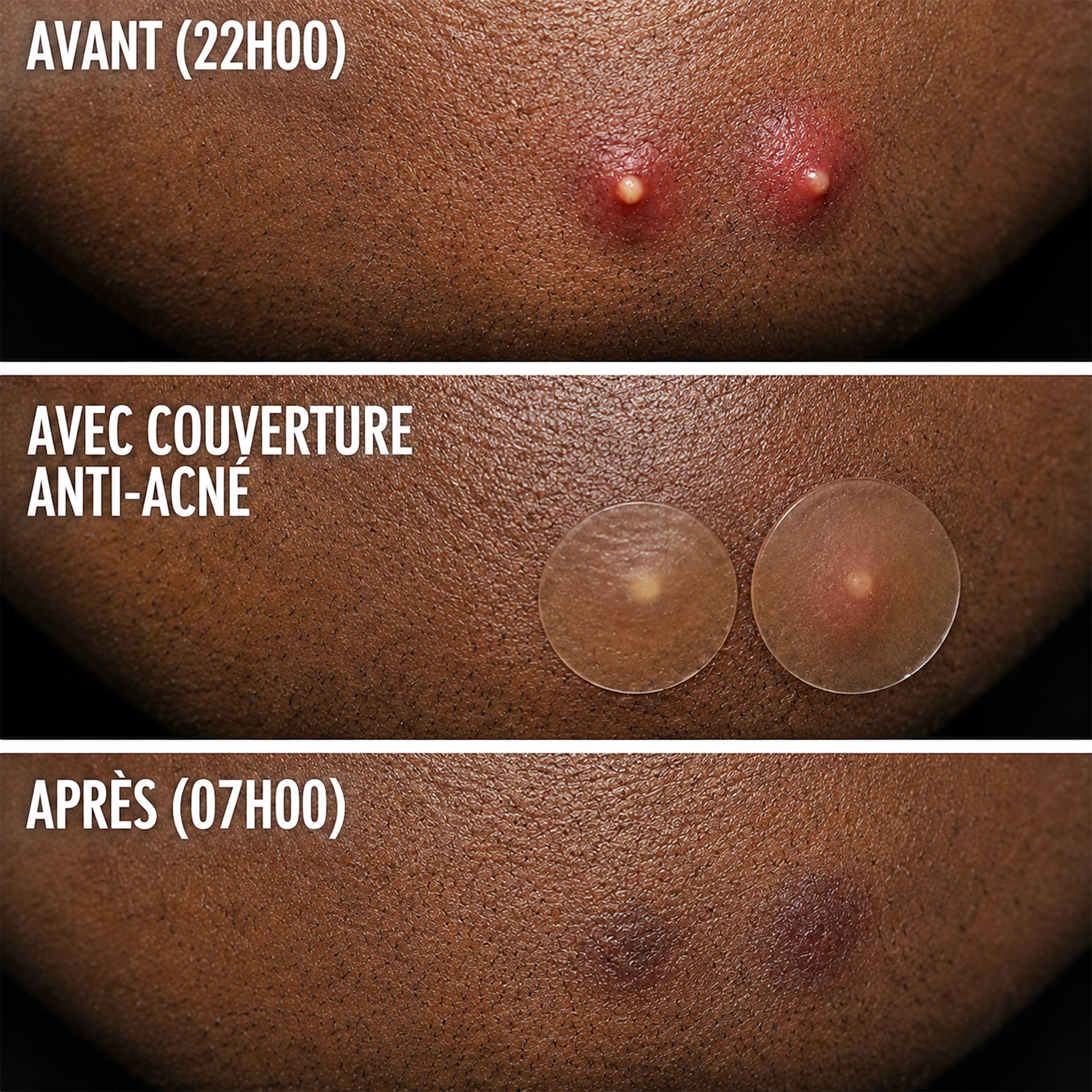 COSRX Acne Pimple Master Patch Anti-imperfections