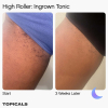 High-roller-ingrow-tonic
