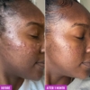 acne-foaming-before-after