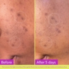 dark-spot-patches
